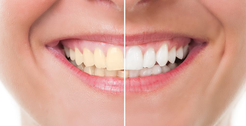 A woman before and after teeth whitening in Canning Vale